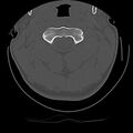 Cervical flexion teardrop fracture with cord hemorrhage (Radiopaedia 32497-33454 Axial bone window 23).jpg