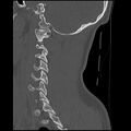 Cervical flexion teardrop fracture with cord hemorrhage (Radiopaedia 32497-33454 Sagittal bone window 34).jpg
