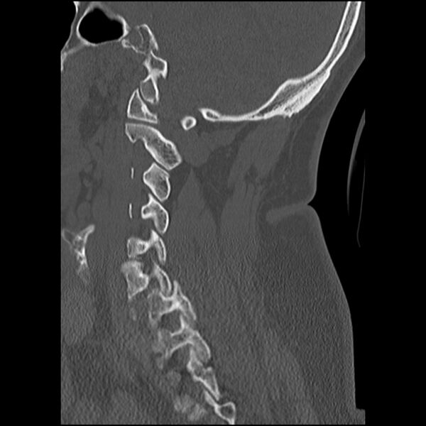 File:Cervical fracture and dislocation with locked facet (Radiopaedia 31837-32780 Sagittal bone window 24).jpg