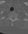 Cervical spine ACDF loosening (Radiopaedia 48998-54071 Axial bone window 55).png