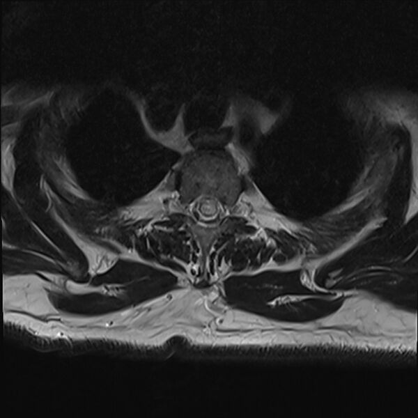 File:Cervical tumor-like myelopathy due to Type V dAVF (Radiopaedia 82461-96604 D 3).jpg