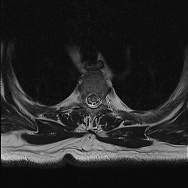 File:Cervical tumor-like myelopathy due to Type V dAVF (Radiopaedia 82461-96604 D 8).jpg