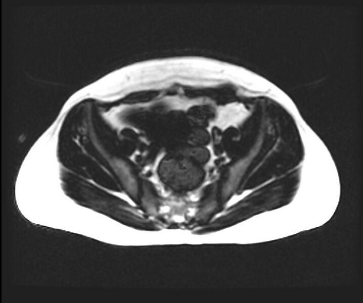 File:Cesarean section scar endometrioma (Radiopaedia 56569-63297 Axial T1 11).jpg