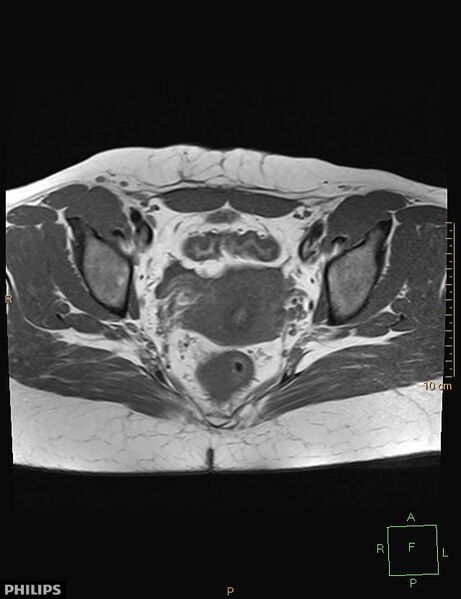 File:Cesarian scar endometriosis (Radiopaedia 68495-78066 Axial T1 15).jpg