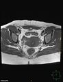 Cesarian scar endometriosis (Radiopaedia 68495-78066 Axial T1 15).jpg