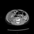 Chance fracture with duodenal and pancreatic lacerations (Radiopaedia 43477-46864 A 24).jpg