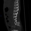 Chance fracture with duodenal and pancreatic lacerations (Radiopaedia 43477-50042 Sagittal bone window 5).jpg