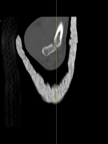 File:Chauffeur's (Hutchinson) fracture (Radiopaedia 58043-65079 Sagittal bone window 22).jpg