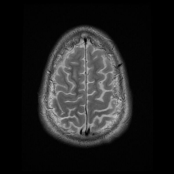 File:Chiasmatic-hypothalamic juvenile pilocytic astrocytoma (Radiopaedia 78533-91235 Axial T2 24).jpg