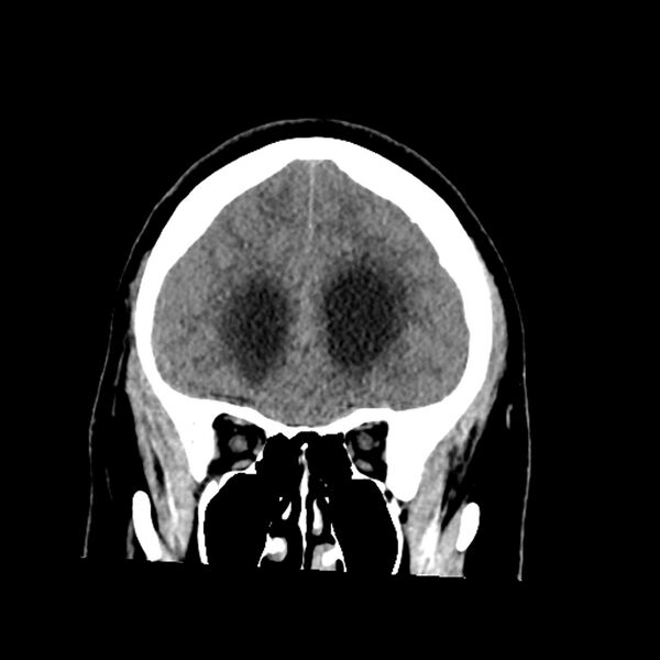 File:Chiasmatic-hypothalamic juvenile pilocytic astrocytoma (Radiopaedia 78533-91237 Coronal non-contrast 21).jpg