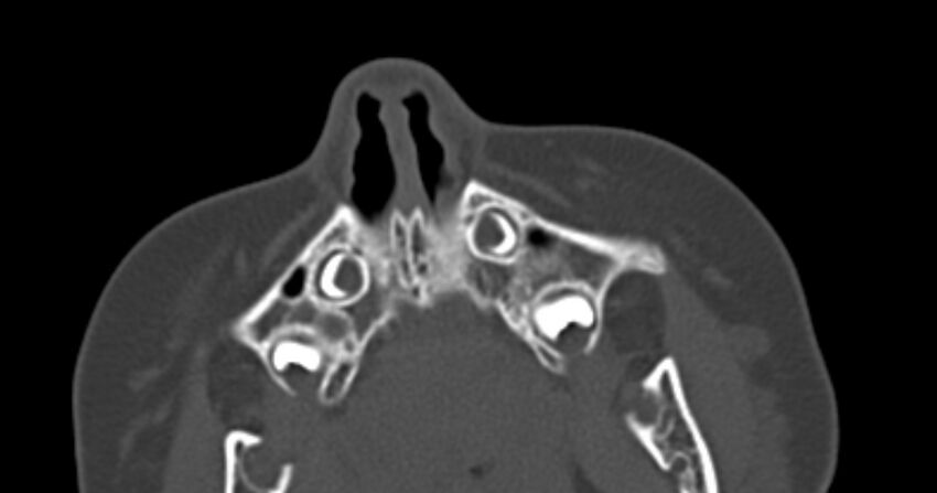 Choanal atresia (Radiopaedia 51295-56972 Axial bone window 7).jpg