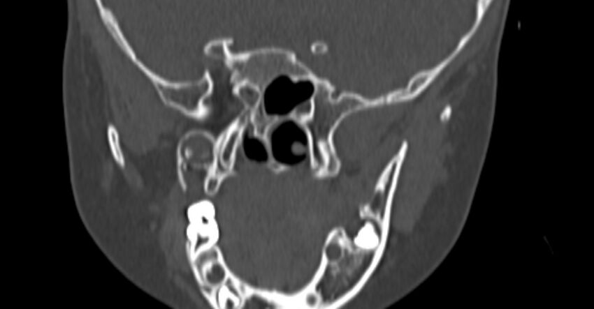 Choanal atresia (Radiopaedia 51295-56972 Coronal bone window 77).jpg