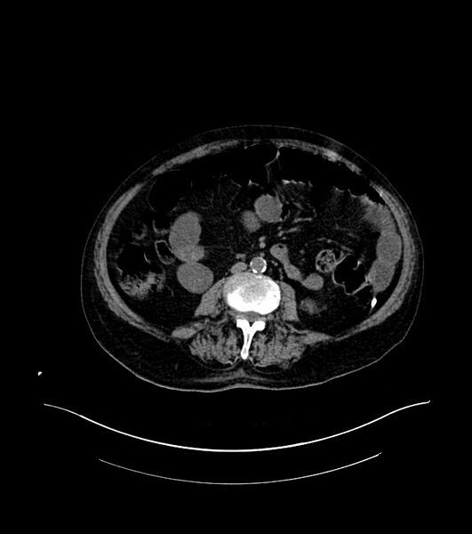 File:Cholangiocarcinoma with cerebral metastases (Radiopaedia 83519-98629 Axial non-contrast 62).jpg