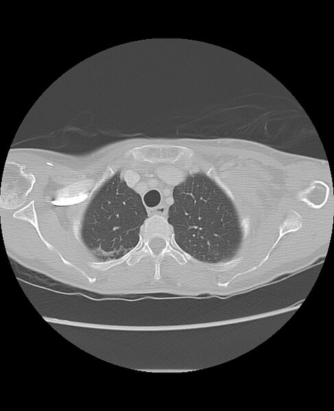 File:Chondrosarcoma (Radiopaedia 79427-92532 Axial lung window 10).jpg