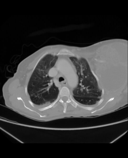 File:Chondrosarcoma (Radiopaedia 79427-92535 Axial lung window 16).jpg