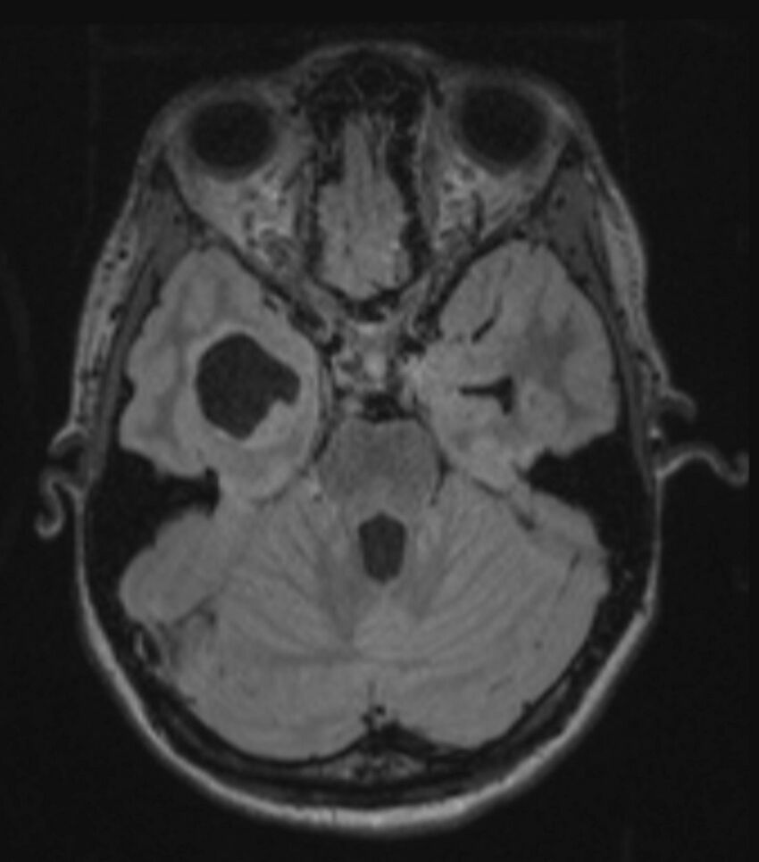 Choroid plexus carcinoma (Radiopaedia 91013-108553 Axial FLAIR C+ 106).jpg