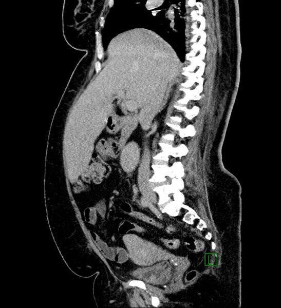 File:Chromophobe renal cell carcinoma (Radiopaedia 84239-99519 G 71).jpg