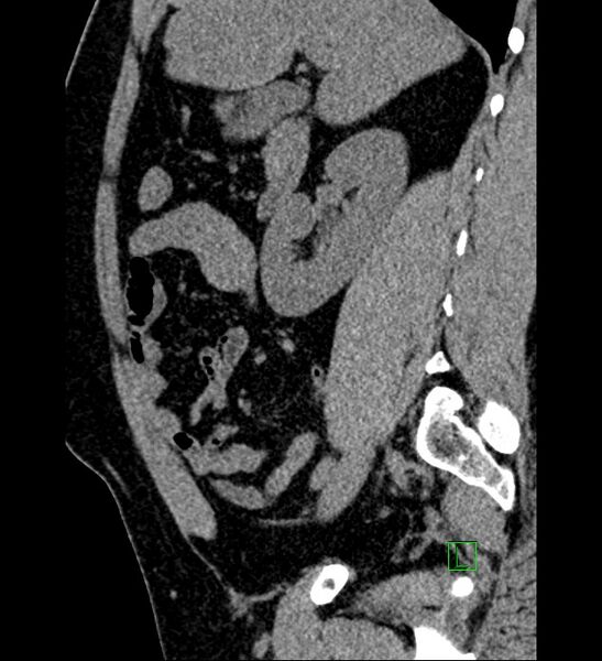 File:Chromophobe renal cell carcinoma (Radiopaedia 84286-99573 C 118).jpg