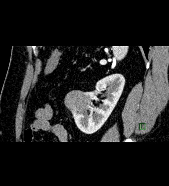 File:Chromophobe renal cell carcinoma (Radiopaedia 84286-99573 F 43).jpg