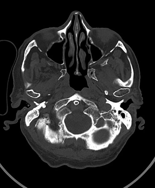 File:Chronic bilateral subdural hygroma (Radiopaedia 85801-101623 Axial bone window 104).jpg