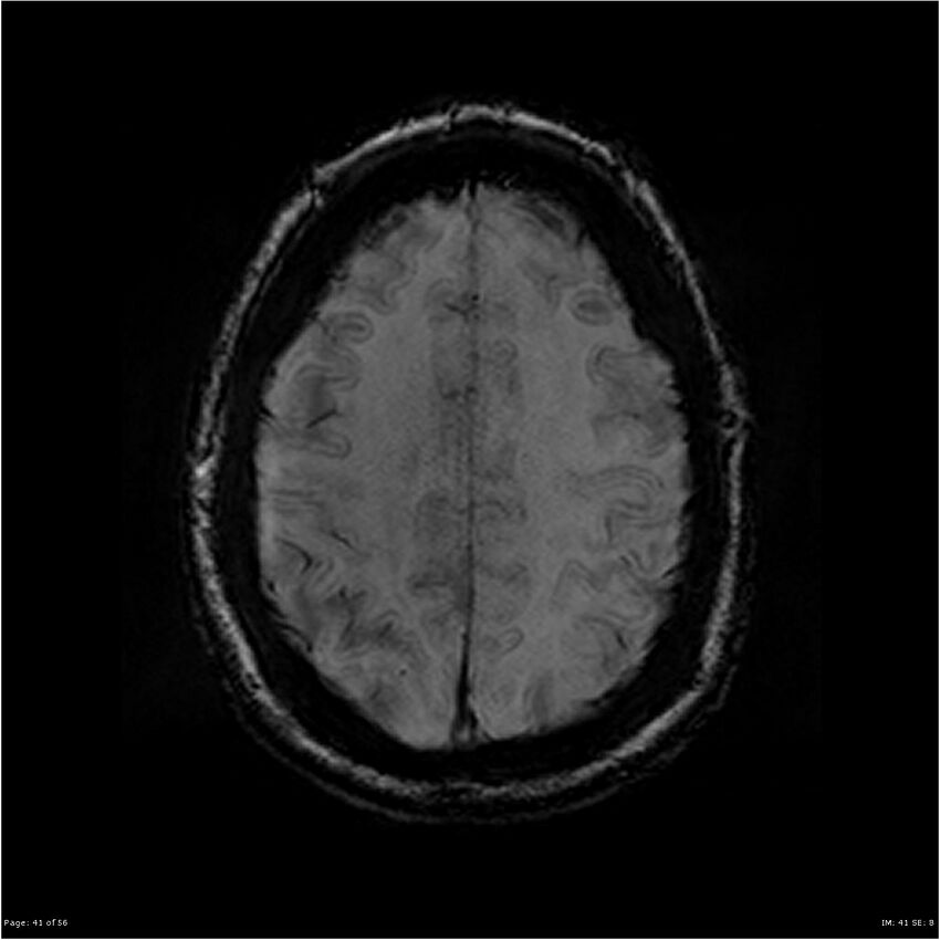 Chronic hypertensive encephalopathy (Radiopaedia 25764-25918 Axial SWI 41).jpg