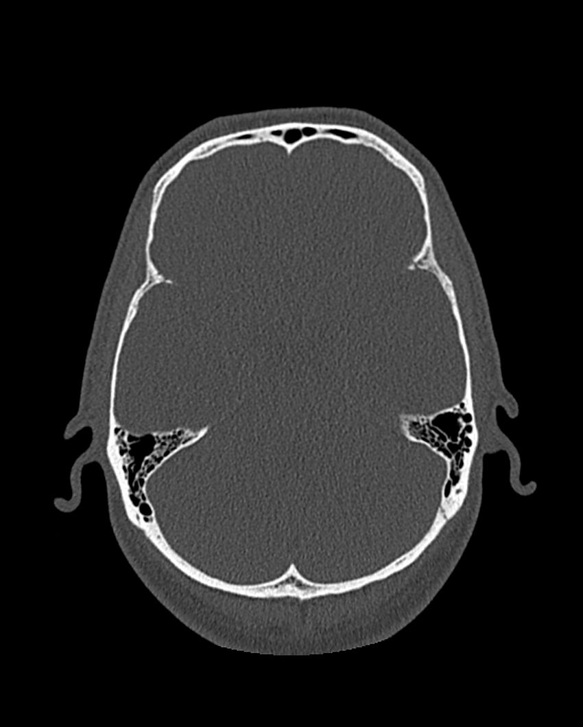 Chronic maxillary sinusitis caused by a foreign body (Radiopaedia 58521-65676 Axial bone window 294).jpg