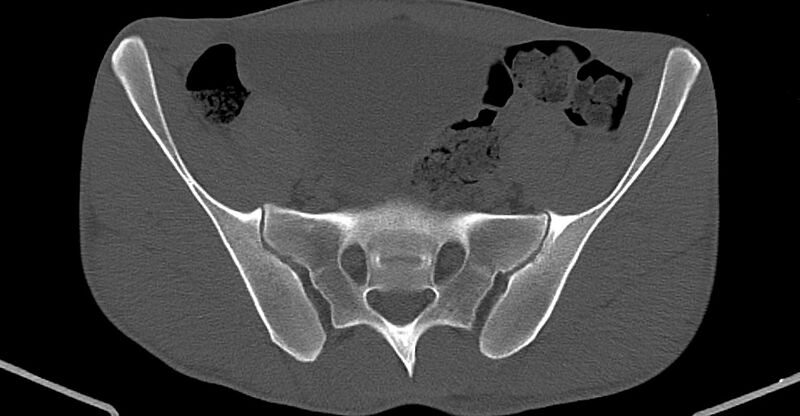 File:Chronic osteomyelitis (with sequestrum) (Radiopaedia 74813-85822 Axial non-contrast 8).jpg
