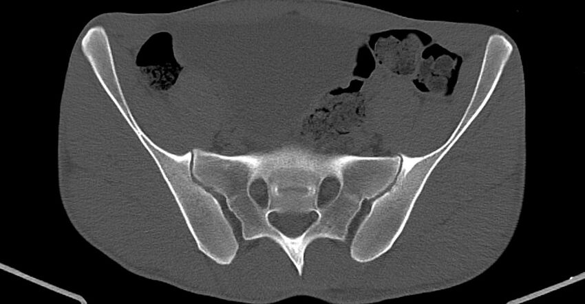 Chronic osteomyelitis (with sequestrum) (Radiopaedia 74813-85822 Axial non-contrast 8).jpg