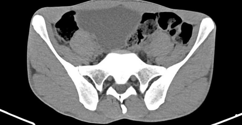 Chronic osteomyelitis (with sequestrum) (Radiopaedia 74813-85822 D 5).jpg