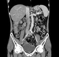 Chronic pancreatitis (Radiopaedia 23132-23172 C 32).jpg
