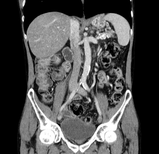 File:Chronic pancreatitis (Radiopaedia 23132-23172 C 32).jpg