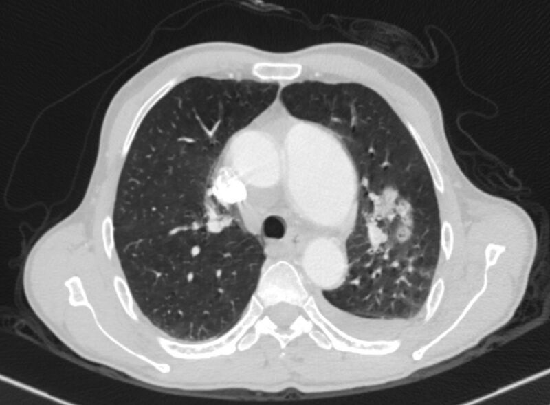 File:Chronic pulmonary embolism with bubbly consolidation (Radiopaedia 91248-108850 Axial lung window 54).jpg