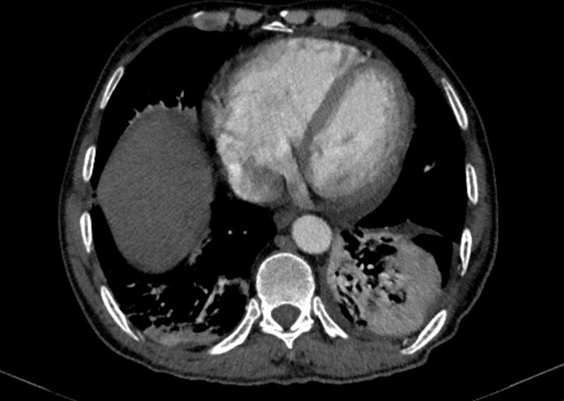File:Chronic pulmonary embolism with bubbly consolidation (Radiopaedia 91248-108850 C+ arterial phase 114).jpg