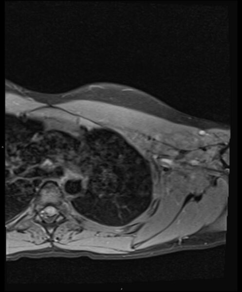File:Chronic reactive multifocal osteomyelitis (CRMO) - clavicle (Radiopaedia 56406-63114 Axial T1 fat sat 19).jpg
