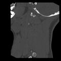 Clay-shoveler fracture (Radiopaedia 22568-22590 Sagittal bone window 1).jpg