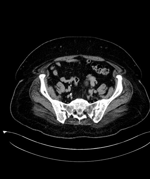 File:Clear cell renal cell carcinoma (Radiopaedia 85004-100537 F 45).jpg