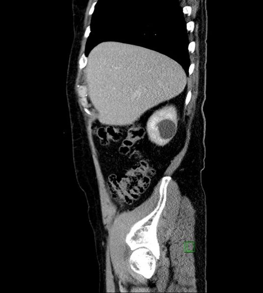 File:Clear cell renal cell carcinoma (Radiopaedia 85006-100539 G 50).jpg