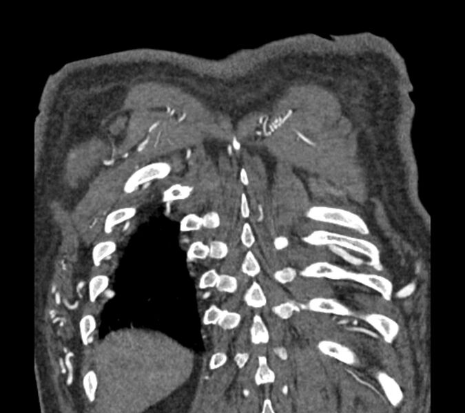 File:Coarctation of the aorta (Radiopaedia 53752-59822 B 76).jpg