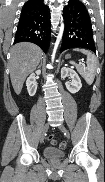 File:Coarctation of the aorta (Radiopaedia 74632-88521 B 151).jpg