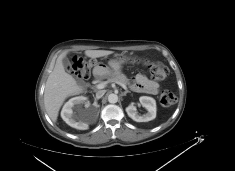 File:Colon cancer mimicking renal cell carcinoma (Radiopaedia 28986-29335 C 23).jpg