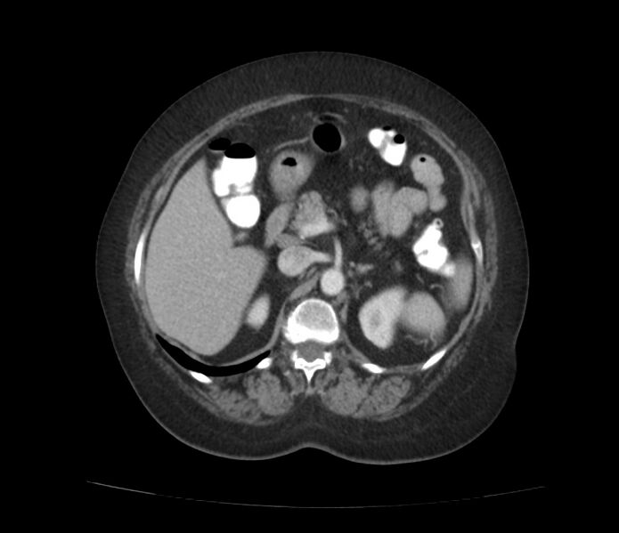 File:Colonic diverticulosis (Radiopaedia 22934-22957 A 23).jpg