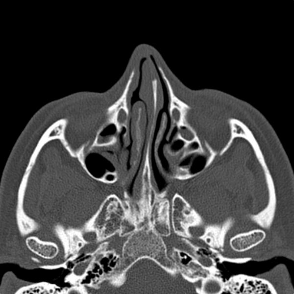 File:Nasal septal perforation (Radiopaedia 25030-25289 Axial bone window 25).jpg