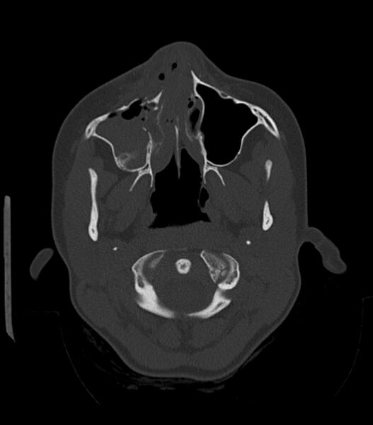 File:Nasoorbitoethmoid fracture (Radiopaedia 90044-107205 Axial bone window 60).jpg