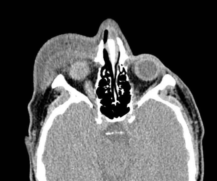 File:Necrobiotic xanthogranuloma- face (Radiopaedia 29549-30052 Axial C+ delayed 5).jpg