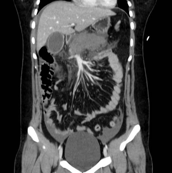 File:Necrotizing pancreatitis (Radiopaedia 23001-23031 B 24).jpg