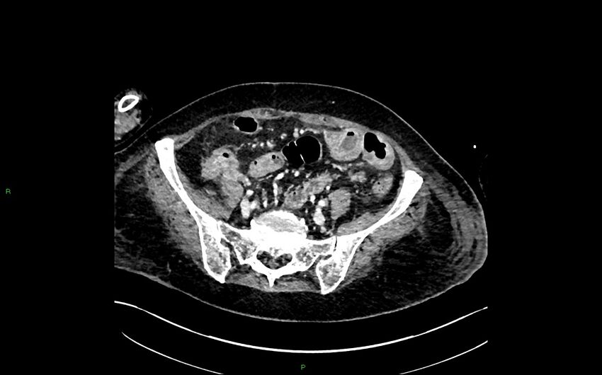 Neo-terminal ileal stricture (Crohn disease) (Radiopaedia 33790-34948 A 345).jpg