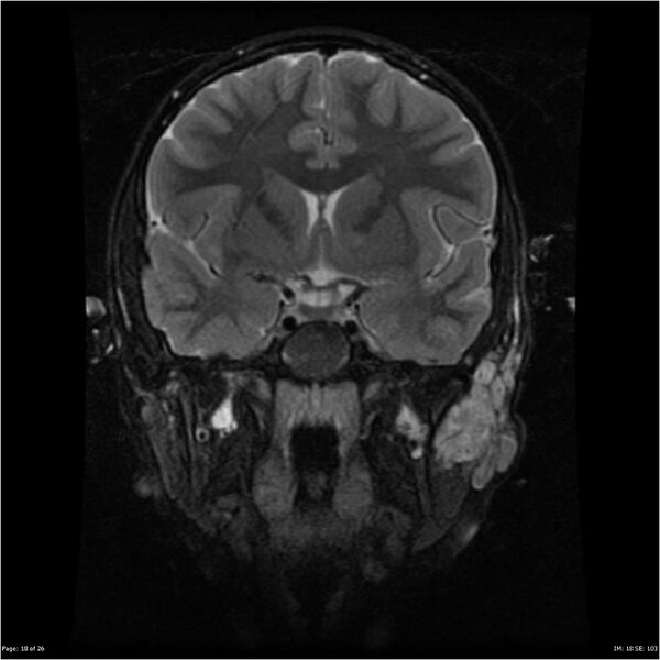 File:Neurofibromatosis type 1 (Radiopaedia 22541-22564 Coronal T2 fat sat 9).jpg