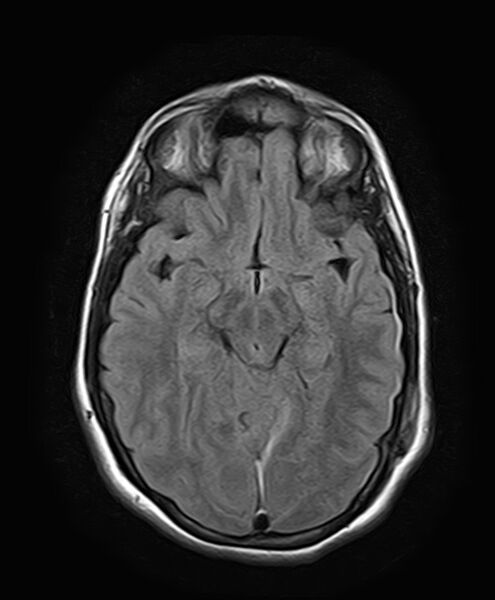 File:Neurofibromatosis type 2 (Radiopaedia 66211-75401 Axial FLAIR 15).jpg
