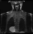 Neurofibromatosis type 2 - cranial and spinal involvement (Radiopaedia 5351-7112 E 3).jpg