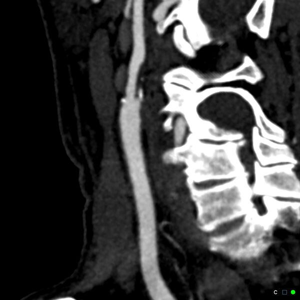 File:Non-occlusive intraluminal internal carotid artery thrombus (Radiopaedia 37751-39658 C 42).jpg